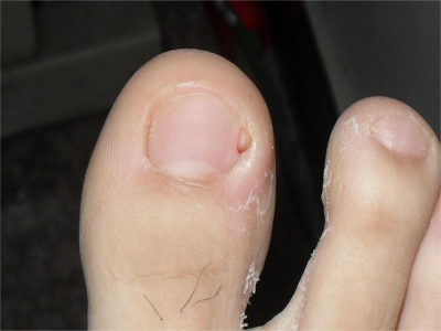 的皮损可见于患者脚趾甲周围,表现为自甲周和甲根部长出淡红的纤维瘤