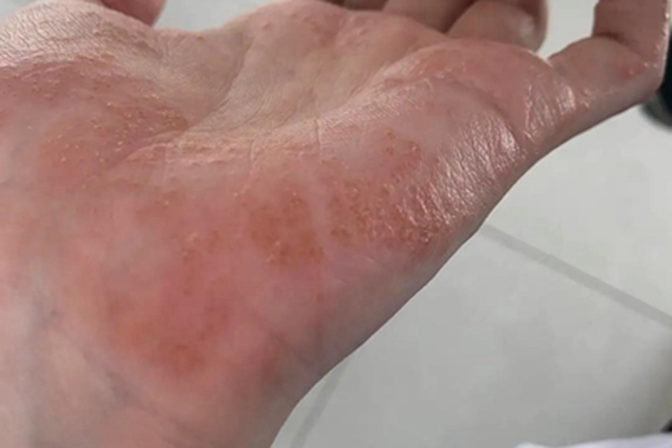 汗疱疹手掌症状图 汗疱疹手掌症状图