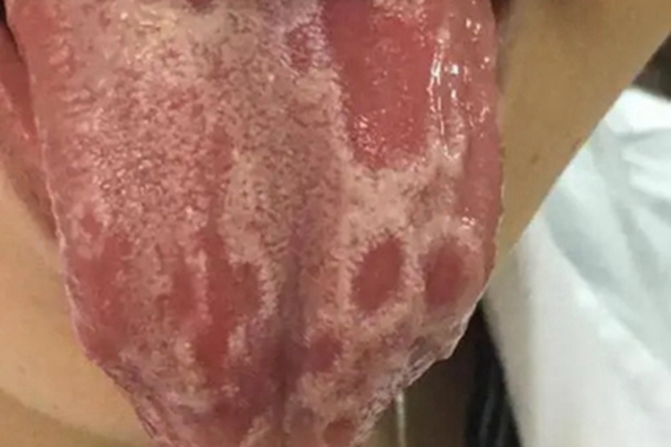 系统性红斑狼疮舌头红斑图