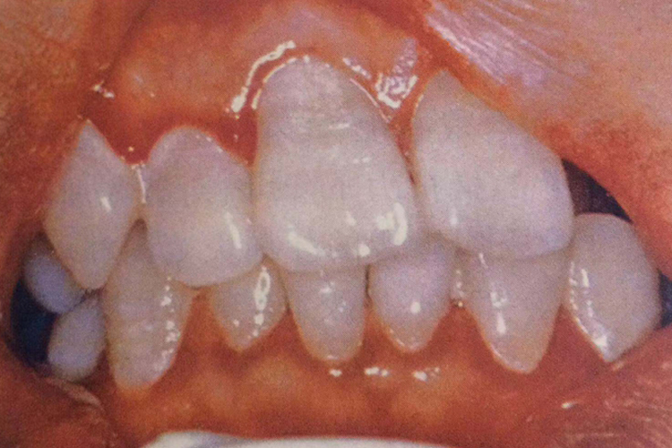 艾滋病线形牙龈红斑图