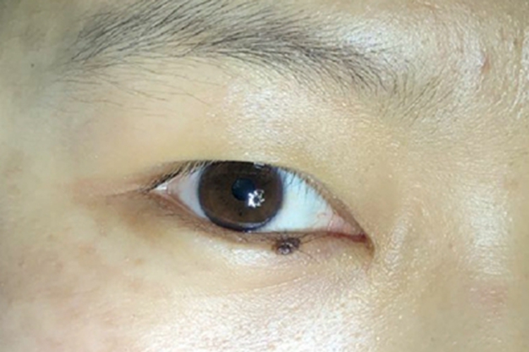 眼睑皮内痣眼睑黑斑图