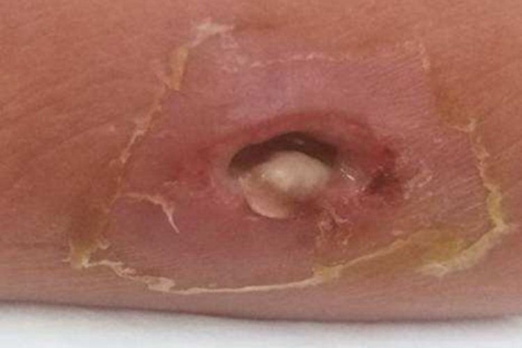 腹部放线菌病腹部窦道症状图