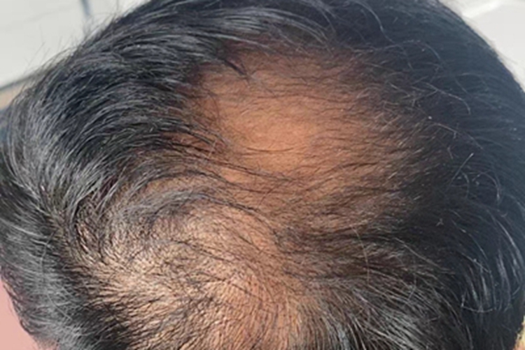 雄激素性脱发头顶上秃了图