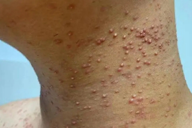 马拉色菌毛囊炎颈部小脓疱图 马拉色菌毛囊炎颈部小脓疱图