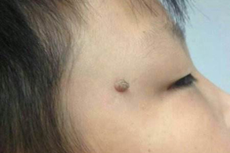 毛囊上皮瘤小疙瘩图