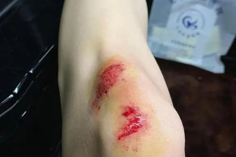 膝盖开放伤图