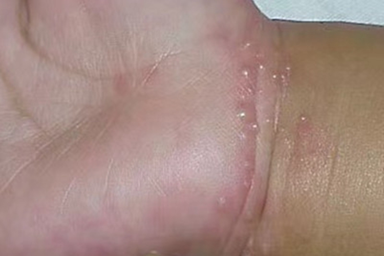 婴儿肢端脓疱病手腕水疱图 婴儿肢端脓疱病手腕水疱图