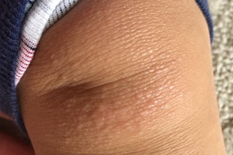 幼年型皮肌炎膝盖症状图