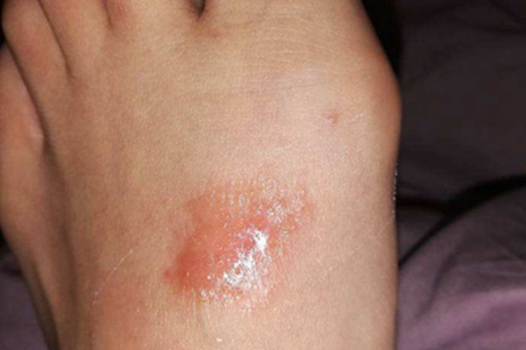 柯萨奇湿疹渗液图