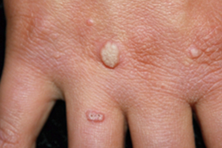 寻常疣手背症状图