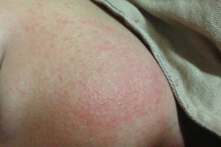 亚急性湿疹面部红点图