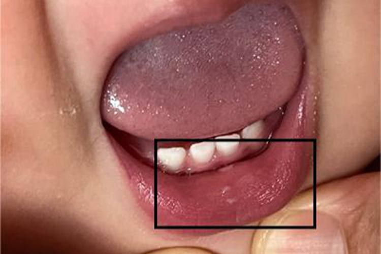 鹅口疮唇内侧白点图