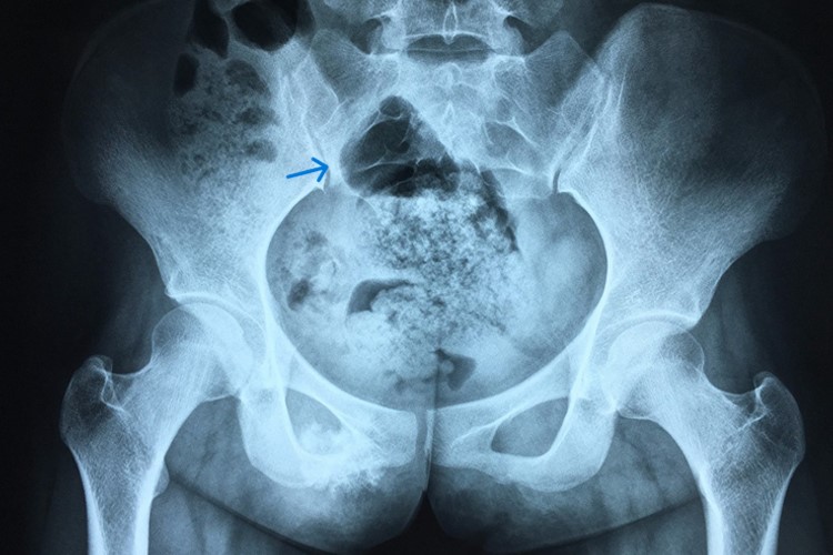女性骨癌疼骨盆肿块影像图