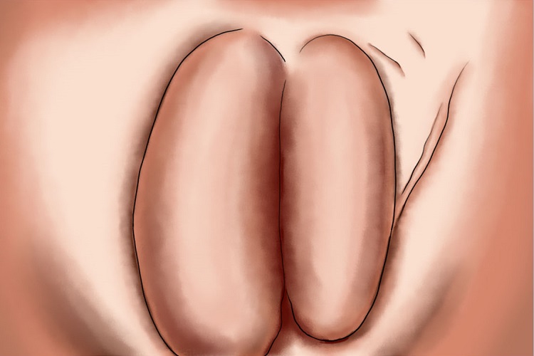 腹股沟肉芽肿肿大手绘图