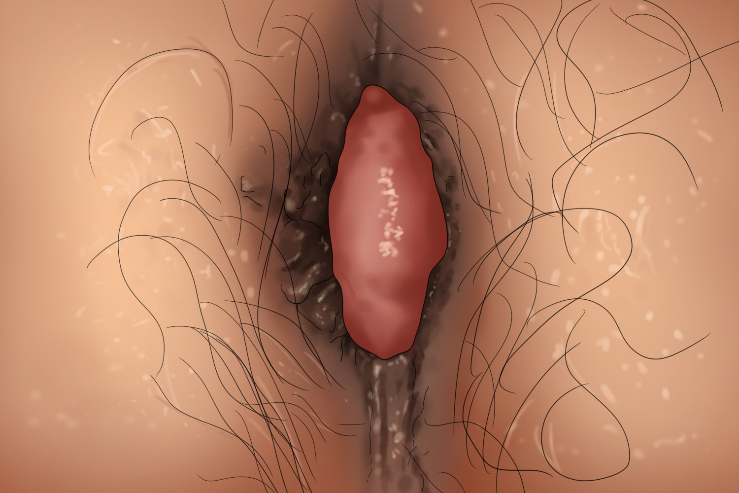血栓性外痔肛门大疙瘩手绘图