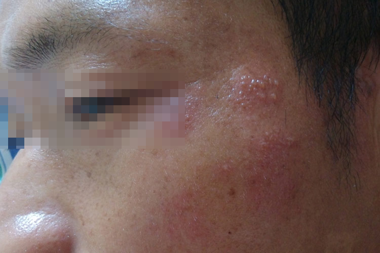 面部轻度带状疱疹图