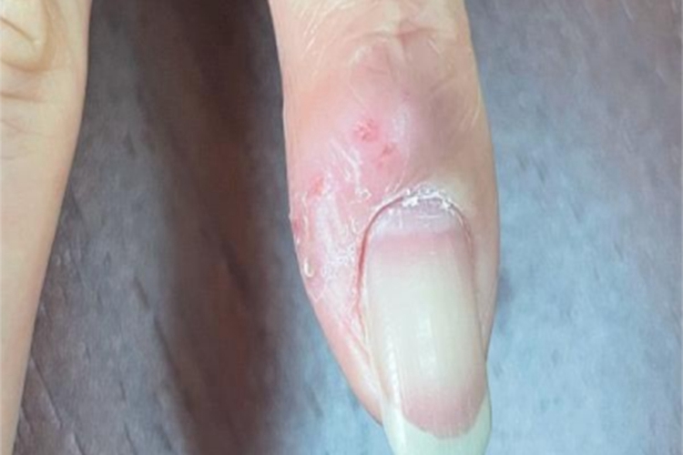 皮肤非典型分枝杆菌病疙瘩图