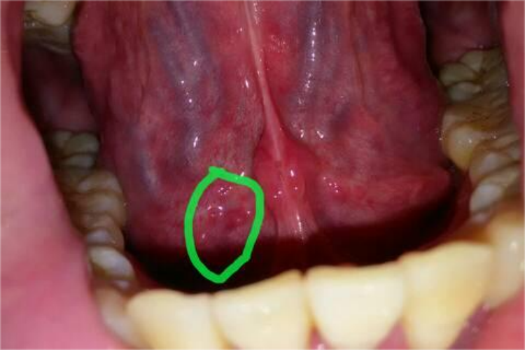 手足口病舌根小疱疹图