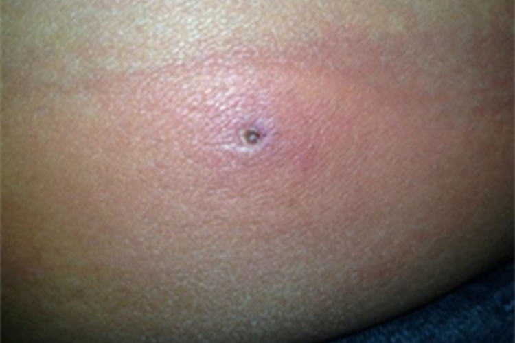 腹部放线菌病腹部肿块症状图