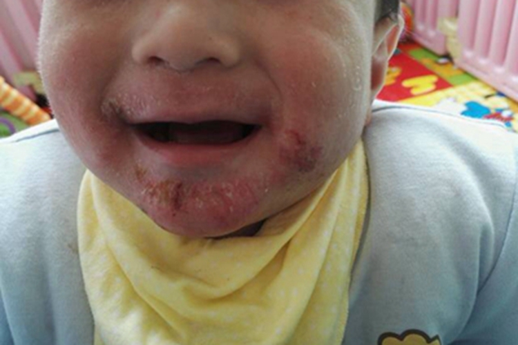 湿疹型药疹结痂图 湿疹型药疹结痂图