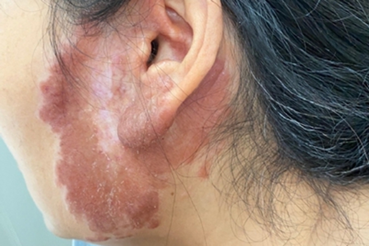 寻常狼疮面部症状图