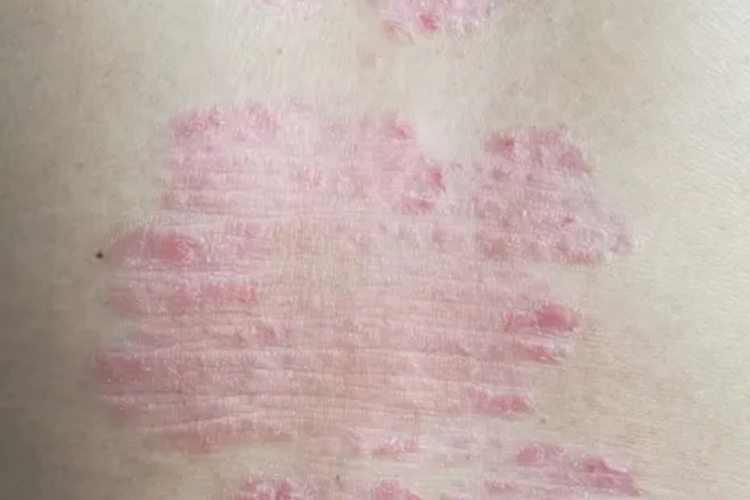 点滴状银屑病退行期图