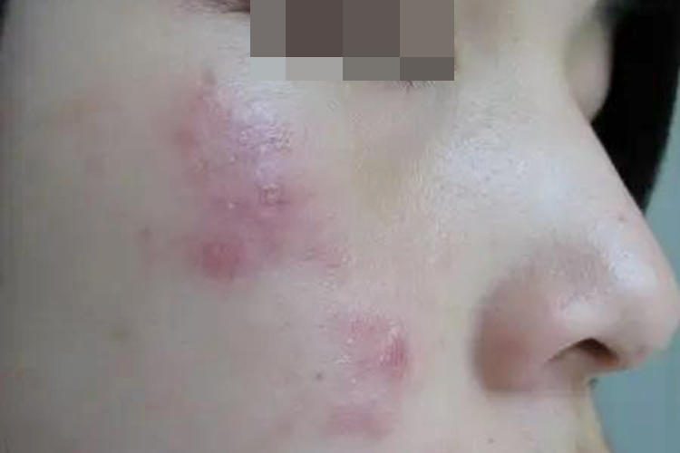 女性面部带状疱疹图