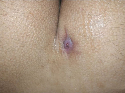 藏毛窦臀部长了一个脓包图.jpeg