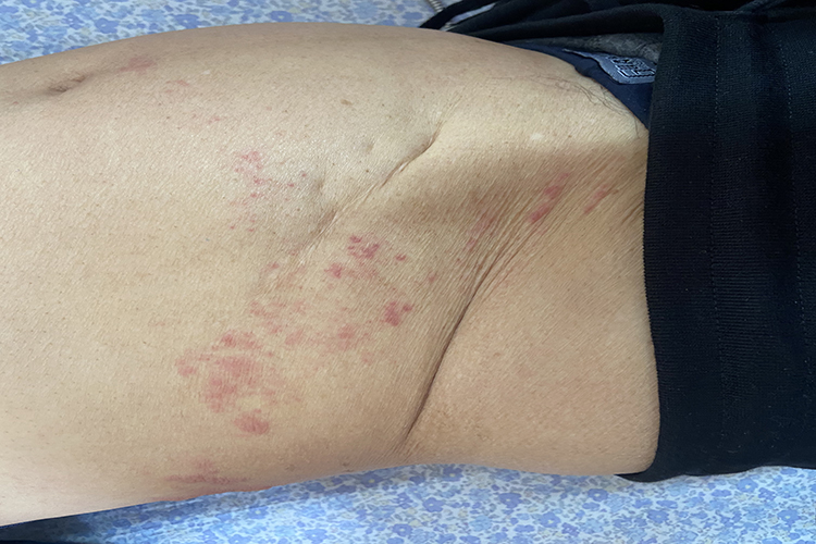 带状疱疹红斑症状图