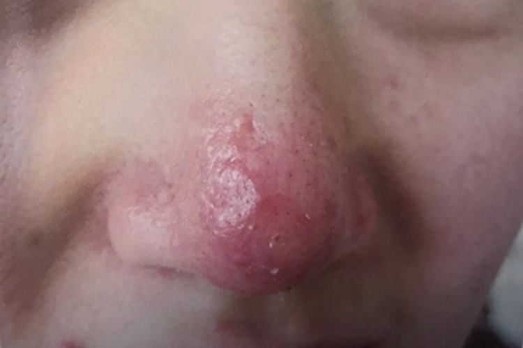 酒糟鼻鼻尖脱皮图