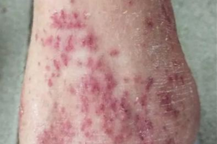 全身性瘙痒症小腿丘疹图