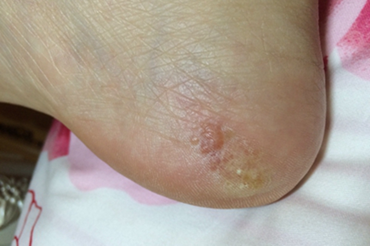 柯萨奇湿疹脚后跟症状图