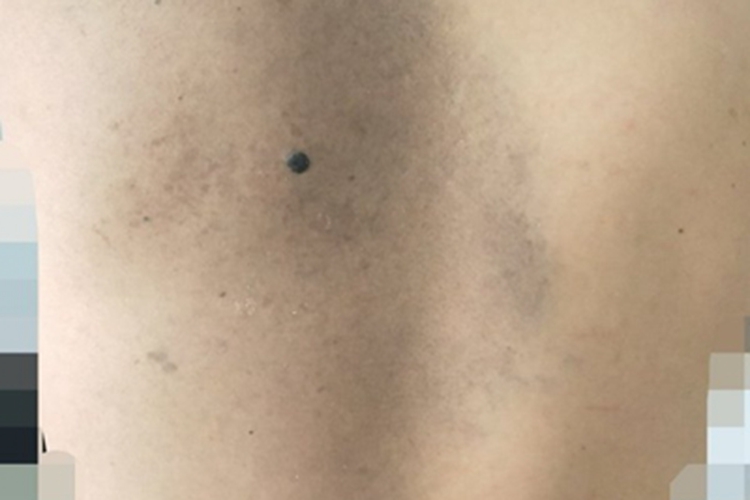 伊藤痣背部一片青灰色斑图