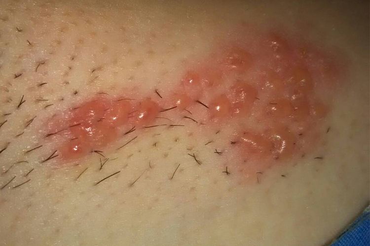 腋下带状疱疹图