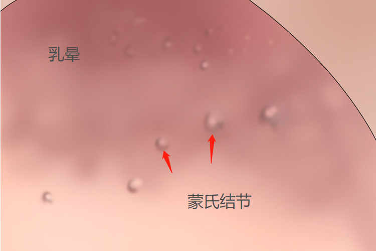 乳晕蒙氏结节小疙瘩图