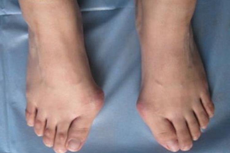 拇趾滑囊炎肿大图