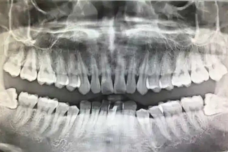 下颌高位阻生智齿图