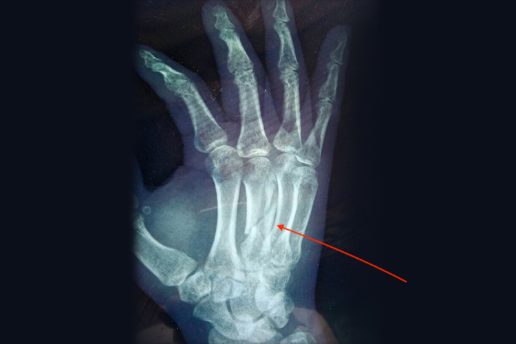手背骨折影像图