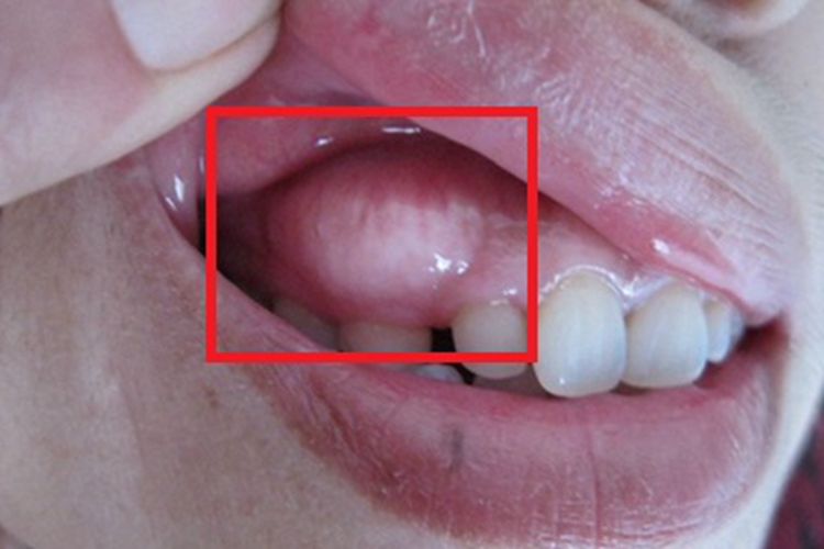 牙龈炎上牙龈有个红肿大包图