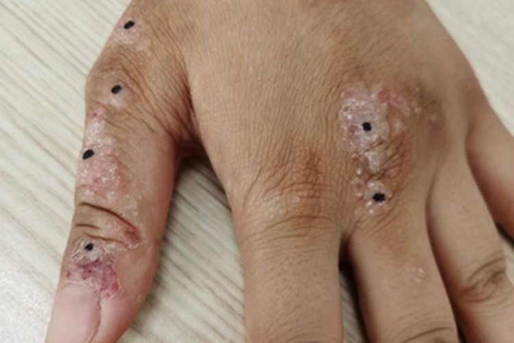 神经性皮炎手背皮肤增厚图