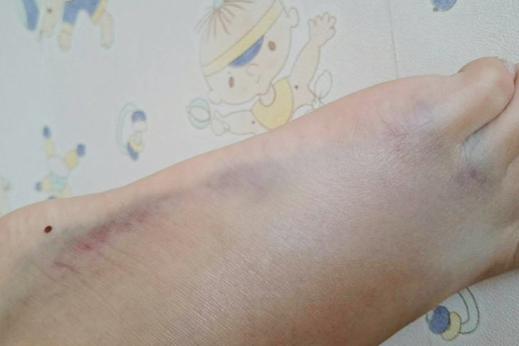 脚背静脉破裂淤血图