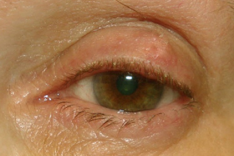 眼眶骨瘤眼部症状图