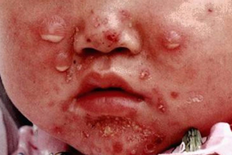 脓疱疮面部水疱图