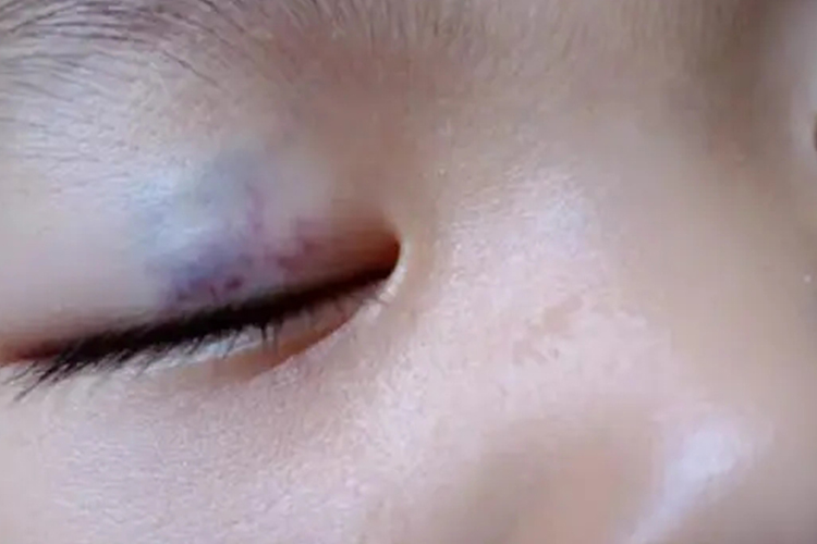 血管畸形眼窝发紫图