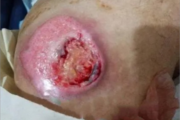 皮肤利什曼病症状图