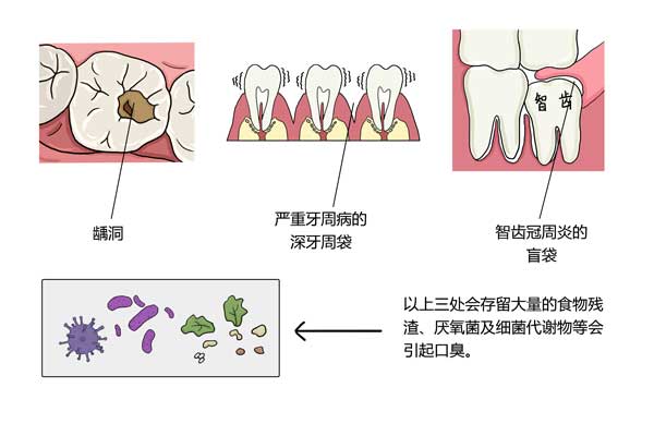 口腔常見疾病,如大的齲洞,嚴重牙周病的深牙周袋,智齒冠周炎的盲袋
