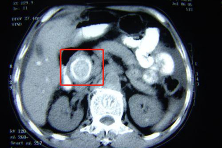 胆总管结石CT“靶征”图