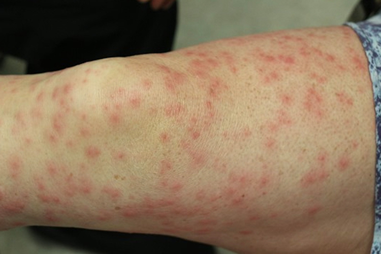 接触性皮炎斑丘疹图