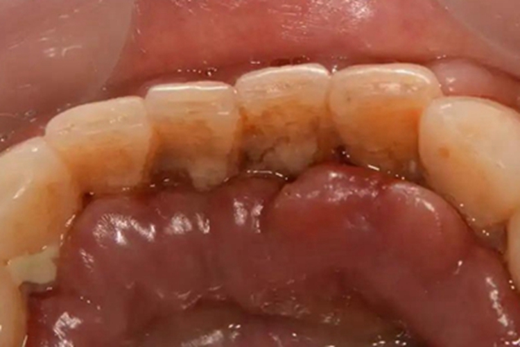 急性白血病牙龈肿了图