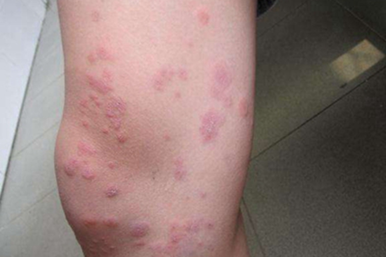 寒冷性多形红斑大腿症状图